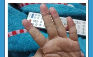 儿童手指头脱皮怎么办