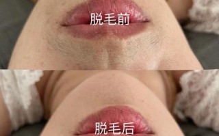 备孕期能做冰点脱毛吗？会对胎儿有影响吗？