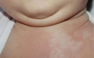 新生儿大理石花纹是疾病信号吗？原因与应对方法全解析