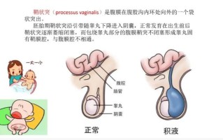 新生儿睾丸鞘膜积液图能直观看到什么？需不需要治疗？