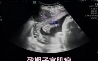 孕期子宫肌瘤真能预示胎儿性别？男孩概率更高有科学依据吗？