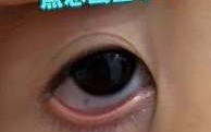 新生儿黑眼球不在中间是先天异常还是发育问题？需警惕哪些眼部疾病风险？