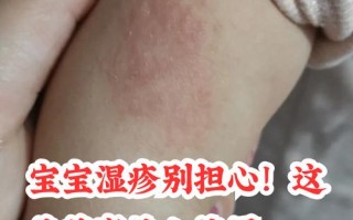 地奈德乳膏儿童使用安全吗？适用年龄与剂量该如何把控？