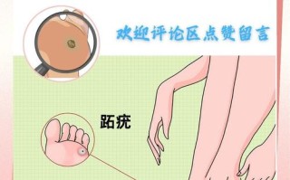 儿童脚上长跖疣，不治会自己好吗？该怎么处理才好？