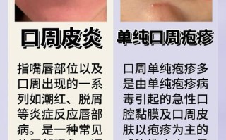 孕期嘴巴长疱疹会影响胎儿吗？该如何安全处理？