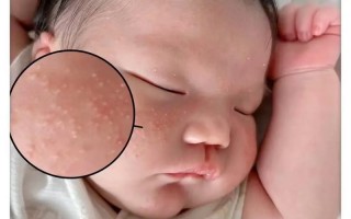 新生儿出生脸上长痘痘是正常现象吗？需要治疗吗？