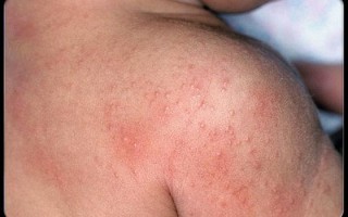 新生儿热疹图片和症状有哪些？如何区分与其他皮疹？