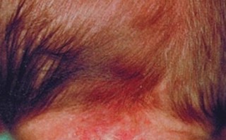 新生儿枕后红斑是什么？需要治疗吗？会自行消退吗？