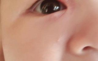 新生儿右眼肿是正常现象还是疾病信号？需要警惕哪些原因？