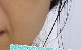 孕期脸上长斑真能预示胎儿性别？科学依据还是民间迷信？