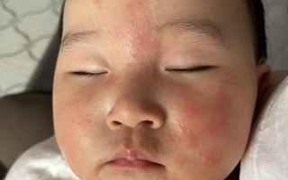 新生儿脸上起湿疹怎么办？日常护理与用药需注意哪些事项？