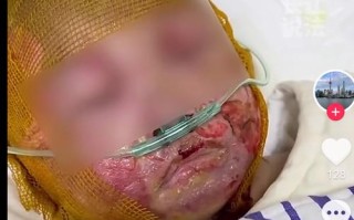 新生儿头被手机砸伤图片引热议，家长该警惕哪些日常安全隐患？