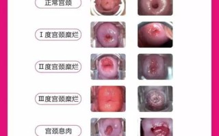 怀孕期间得了宫颈糜烂会对胎儿有影响吗？需要治疗吗？