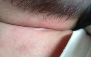 新生儿脖子红疙瘩带白点是湿疹还是感染？该如何正确护理？
