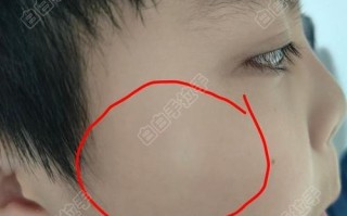 儿童皮肤白斑初期症状