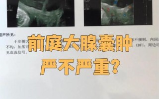 孕期前庭大腺囊肿很大，会影响分娩吗？需要提前处理吗？