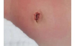 新生儿十几天肚脐出血是正常现象还是异常情况？该如何正确护理？