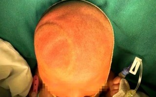 新生儿没有头芯正常吗？这可能是哪些原因导致的？