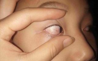 8岁儿童眼睛有红血丝