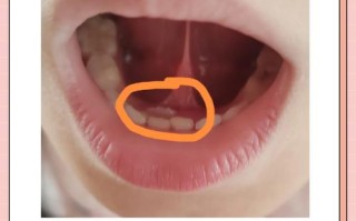 儿童恒牙长出乳牙未脱落怎么办？