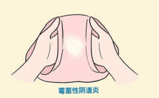 孕期阴道异味是何原因导致？