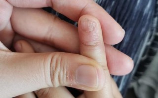 儿童手指甲坑坑洼洼是缺什么吗？
