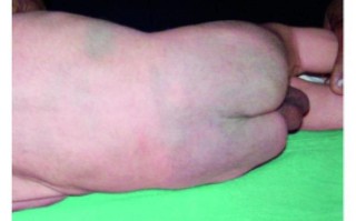 新生儿出生时身上有淤青正常吗？这些图片背后的原因是什么？