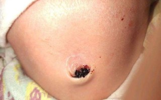 半个月新生儿肚脐出血，需要立即就医吗？还是在家护理就能止血？