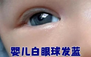 新生儿巩膜为什么是蓝灰色的？正常还是异常？何时会变成白色？