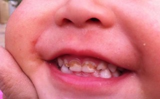 新生儿牙齿上的黄黄东西是正常现象还是需要处理的牙菌斑？