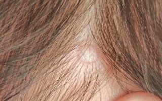 新生儿头上长小白泡是什么原因？需要治疗吗？