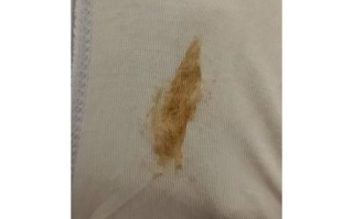 孕期白带有褐色丝状物是先兆流产信号还是妇科炎症？