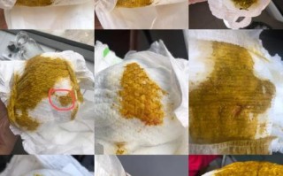 新生儿一直拉尿不拉屎