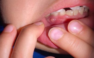 儿童牙龈凸起肉疙瘩是何问题？