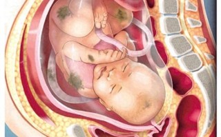 胎粪吸入会影响新生儿智力吗？