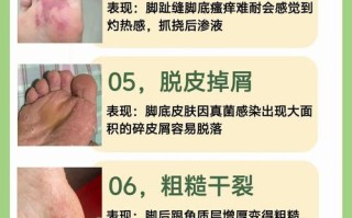 儿童脚气反复难除根？日常护理+科学用药如何双管齐下根治？