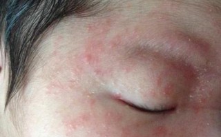 新生儿伤热有什么症状