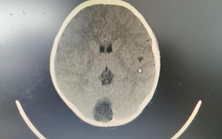 儿童蛛网膜囊肿症状有哪些？