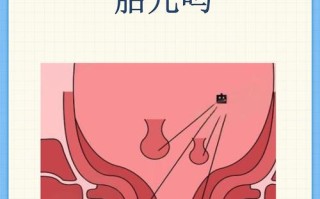 孕期痔疮出血会影响胎儿健康吗？需要如何处理才能保障母婴安全？