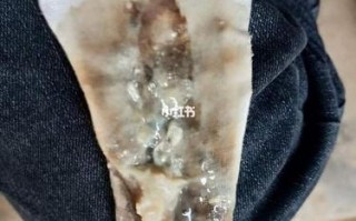 孕期盆腔积液会自行排出吗？对胎儿有影响吗？需要治疗吗？