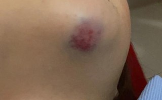 新生儿宝宝下巴出现硬块是什么原因？需要担心吗？