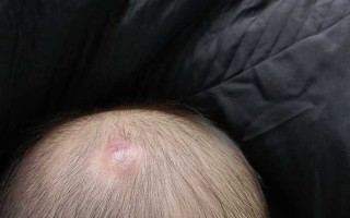 新生儿头皮血管瘤图片长什么样？不同类型有什么区别？需要治疗吗？