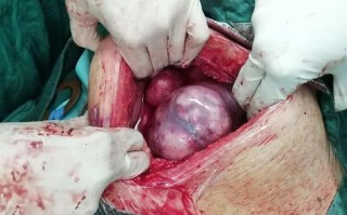 怀孕期间子宫肌瘤为何会突然增大？对母婴有影响吗？