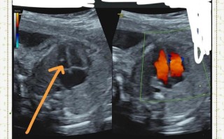 孕期检查胎儿有强光点是异常信号吗？需要做哪些进一步检查？