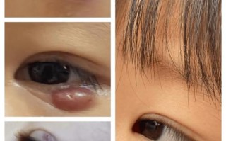新生儿眼周小米粒疙瘩是啥？要紧吗？