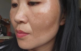 孕期长蝴蝶斑真能预示生女儿吗？科学依据是什么？