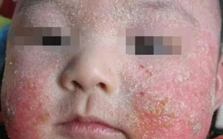 新生儿脸上结痂是正常现象吗？该如何正确护理避免感染？