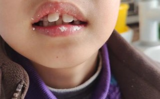 新生儿嘴唇下面肉凸起