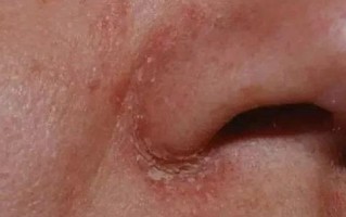 孕期过敏性鼻炎鼻子干，该如何安全缓解不适？