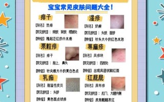 新生儿湿疹和痱子怎么区分？症状、护理方法大不同！